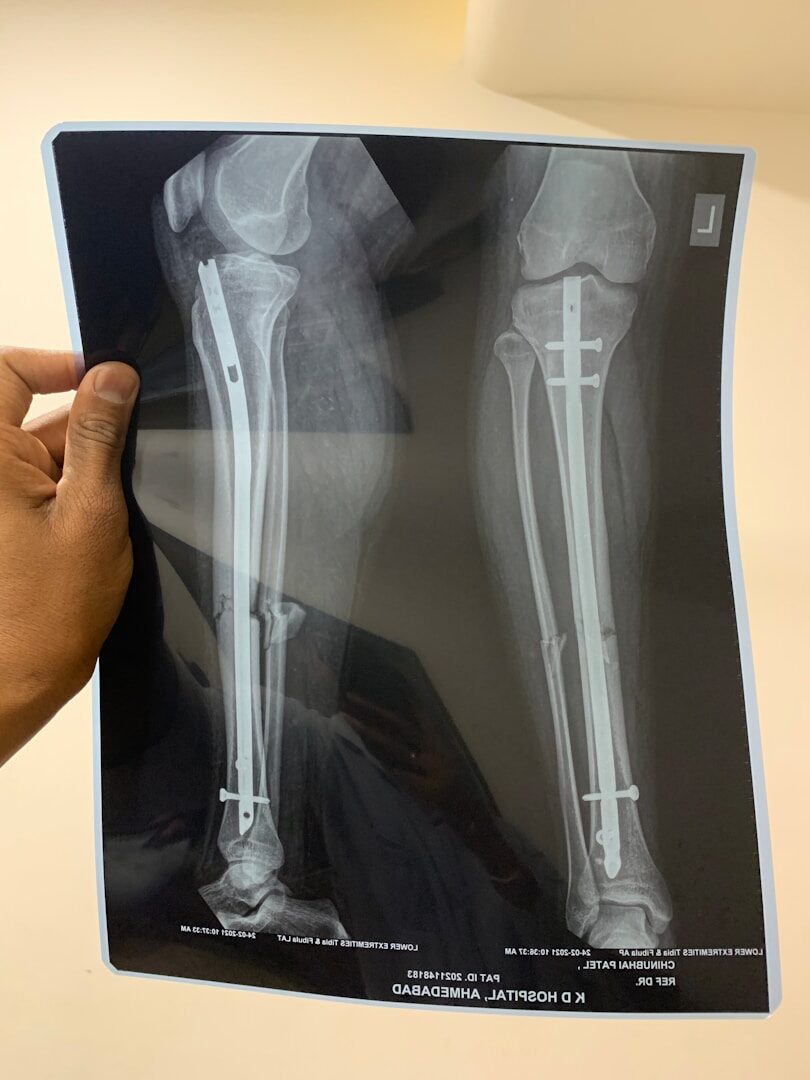 Chez les personnes âgées, les fractures osseuses constituent un problème très complexe. Malheureusement, elles sont fréquentes, surtout chez les femmes.