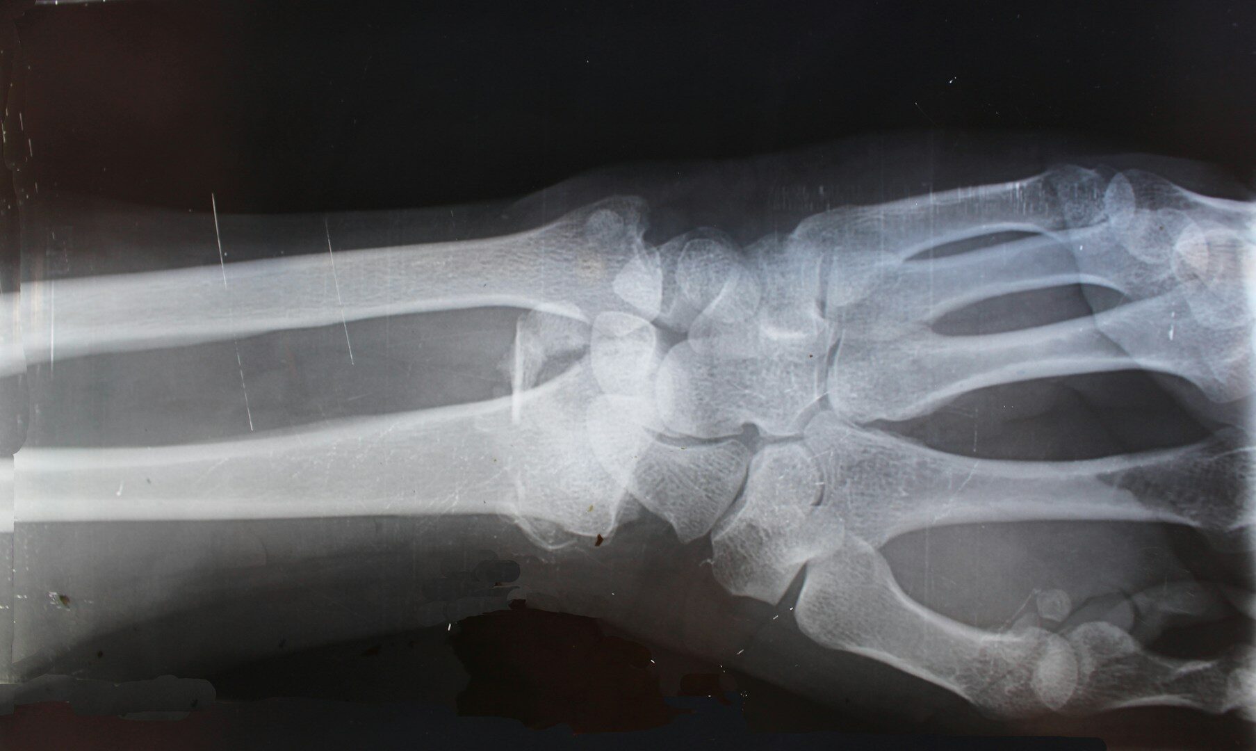 Le gonflement apparaît. Les radiographies révèlent une fracture. Mais vous ne ressentez aucune douleur.